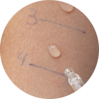Skin Prick Test (SPT)